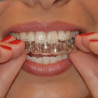 Carillas dentales