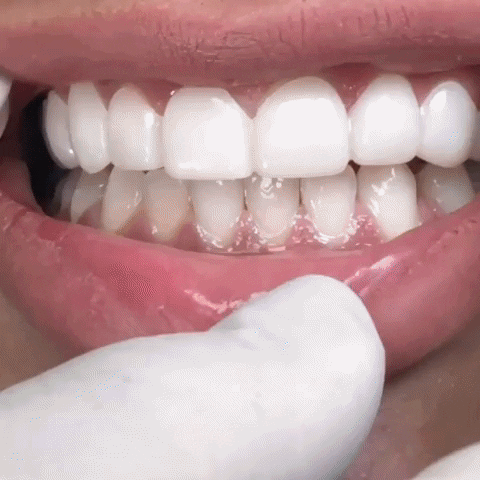 Recupera tu sonrisa al instante sin ir al dentista
